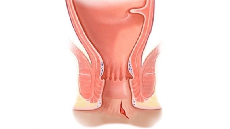 Как вылечить трещину в заднем проходе