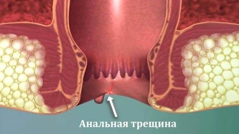 трещина в заднем проходе у ребенка лечение комаровский