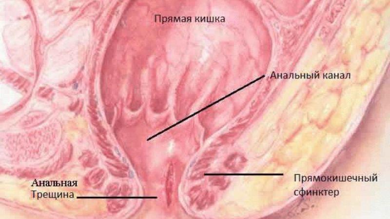 лечение у детей анальных трещин