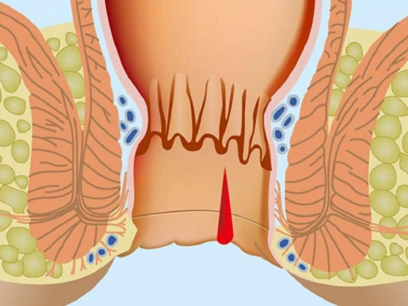 трещина прямой кишки лечение симптомы