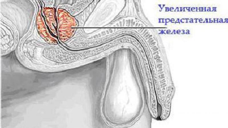 симптомы хронического простатита у мужчин и его лечение