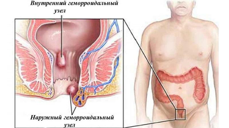 у мужчин в заднем проходе шишка