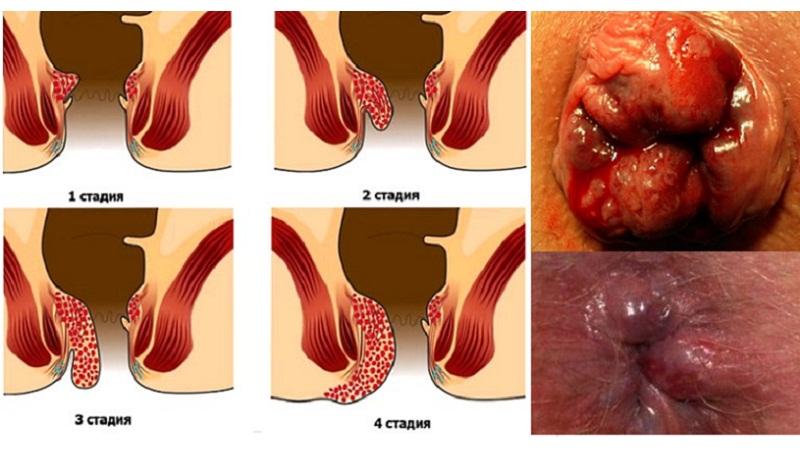 вылезла шишка в заднем проходе как лечить в домашних условиях