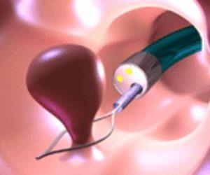 полипы в прямой кишке нужно ли удалять