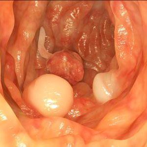полип прямой кишки лечение без операции