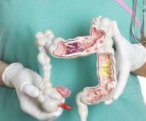 аденокарцинома прямой кишки лечение