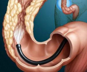 аденома карцинома прямой кишки