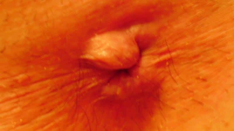 узел геморроя как убрать