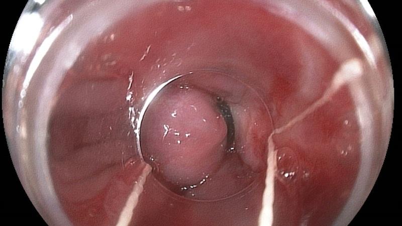 как убрать геморроидальные узлы наружные