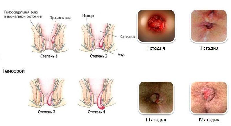 как долго лечится геморрой наружный