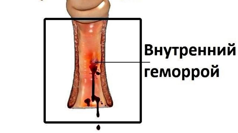 внутренний геморрой с кровотечением лечение