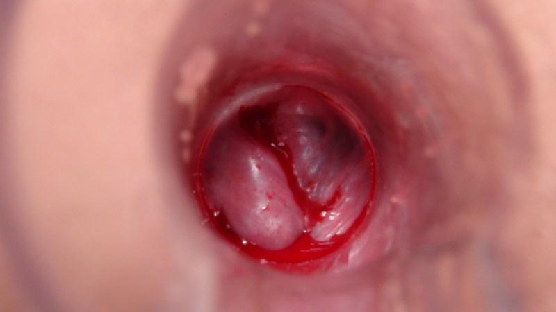 свечи при внутреннем геморрое с кровотечением