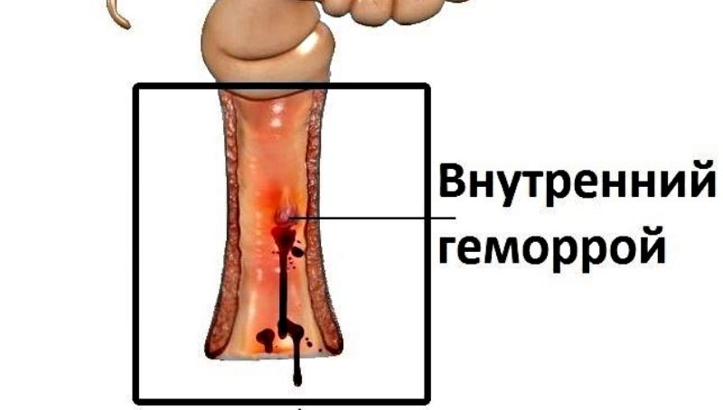 Чем лечить внутренний геморрой