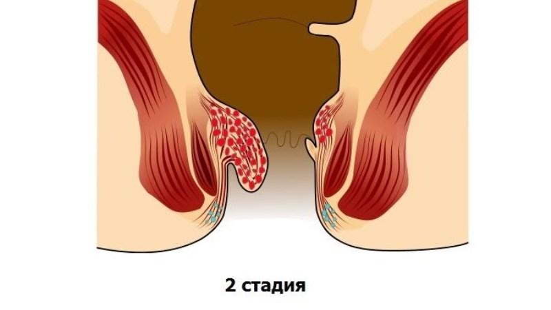 Чем лечить внутренний геморрой
