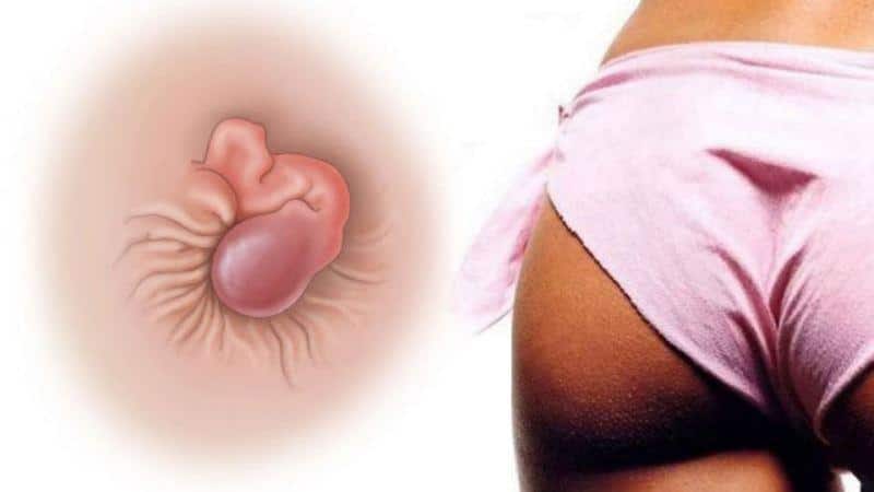 воспаление на анусе