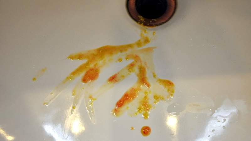 выделение слизи изпрямой кишки причины