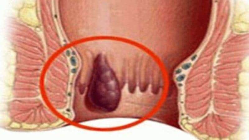 выпадение узлов геморроидальных лечение