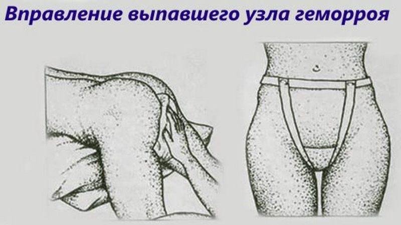выпадение геморроидальных узлов из заднего прохода