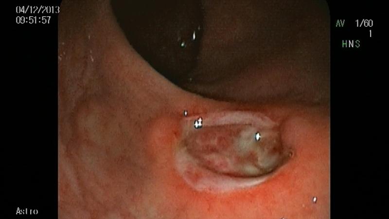 язва прямой кишки симптомы лечение