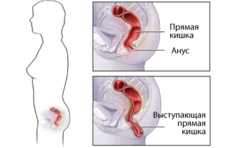 болезни прямой кишки и заднего прохода симптомы