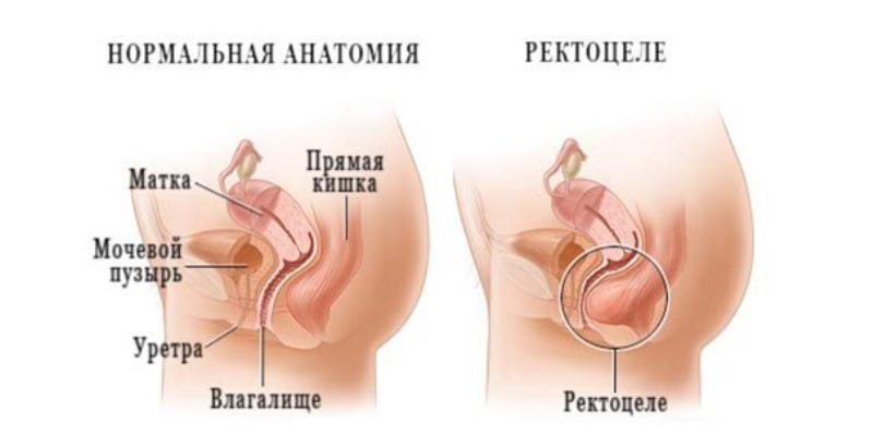 болезни прямой кишки и заднего прохода симптомы