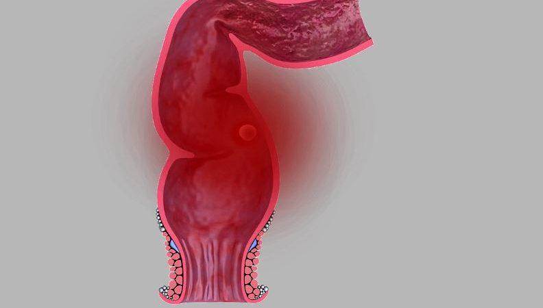 проблемы с кишкой прямой