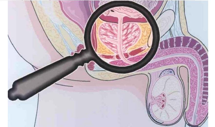 зачатие и хронический простатит