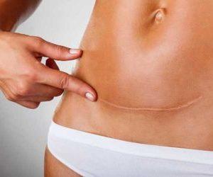 Причины и методы лечения запоров после кесарева сечения