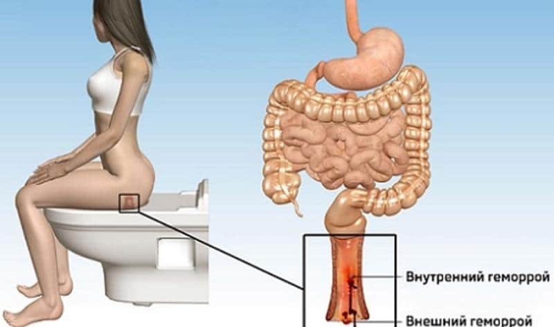 запор при геморрое что делать