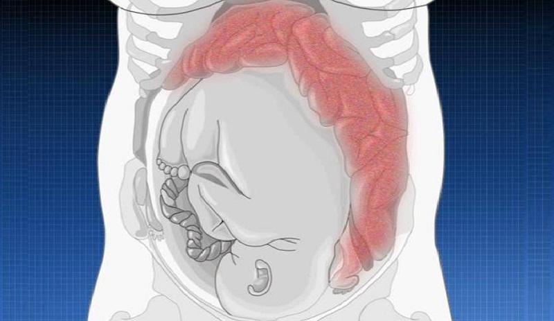 от чего бывают запоры у женщин и как их лечить