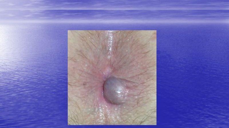 жжение и зуд в заднем проходе у мужчин причины и лечение в домашних условиях